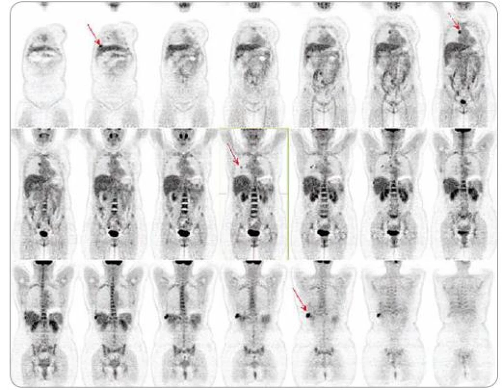 Vstupní PET/CT vyšetření. Vstupní celotělové PET/CT vyšetření zobrazilo metastatická ložiska s patologickou kumulací FDG v oblasti plic, mediastina a 9. žebra vpravo.