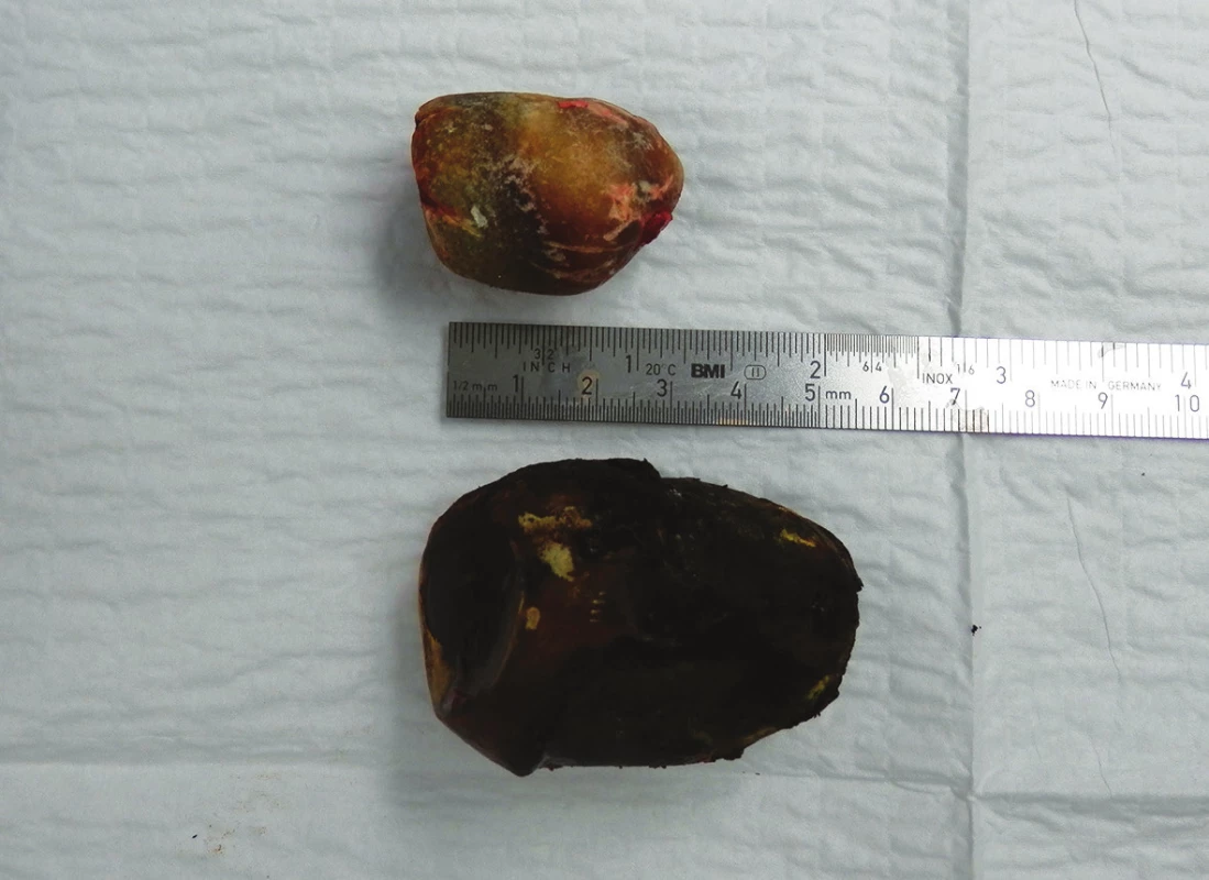 Odstraněné žlučové kameny z duodena
Fig. 7: Gallstones extracted from the duodenum