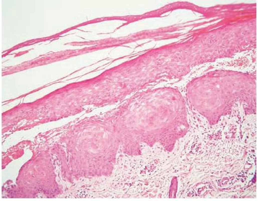 Subepidermální bula s pokročilou reepitelizací spodiny, na pravé straně buly erytrocyty (HE, 200x)