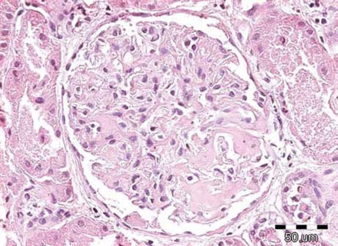 Renální amyloid vždy postihuje glomeruly, dále jsou obvykle zřetelná depozita ve stěnách cév, často v intersticiu a podél bazálních membrán. Amyloid má podobu homogenních depozit, která se barví  světle růžově při rutinním barvení hematoxylin-eozinem, jsou eozinofilní. Na obrázku je detail normocelulárního glomerulu s depozity eozinofilních bezstrukturních hmot v mezangiu u pacienta s AL-amyloidózou. Barvení hematoxylin-eozinem, původní zvětšení 200krát.