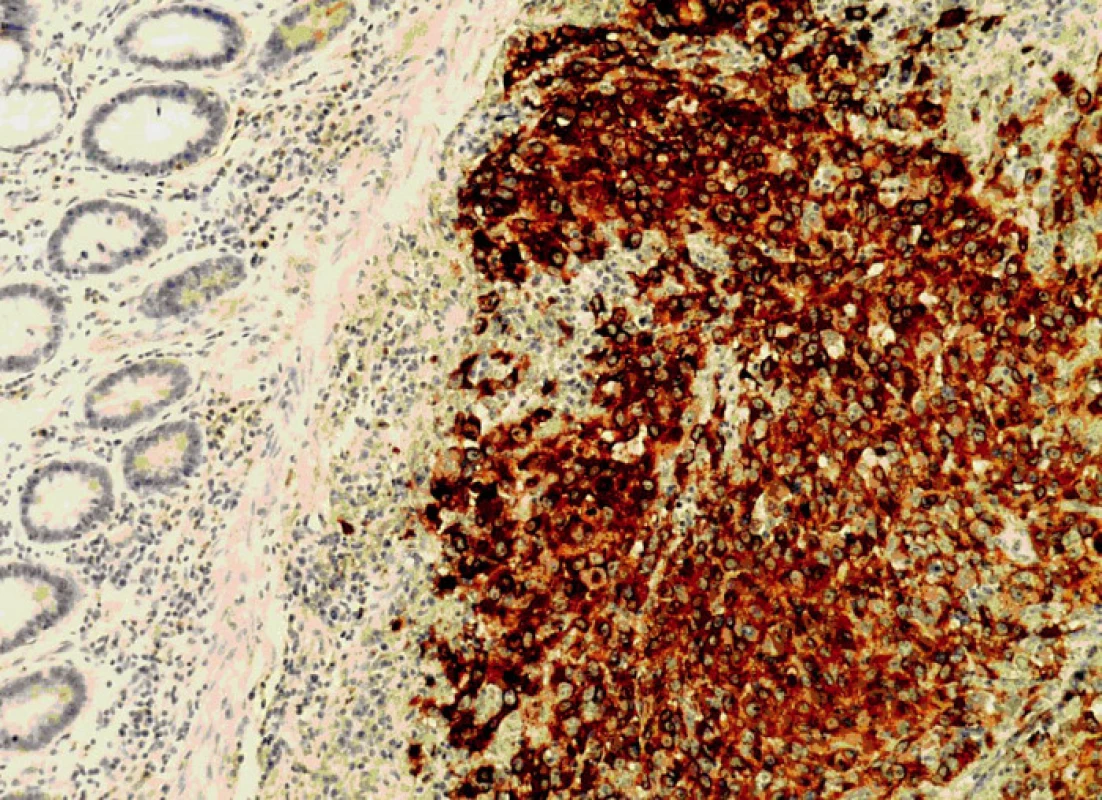 Exprese HMB 45 nádorovými buňkami (100x)
Fig.7. The expression HMB 45 of the tumor cells (100x)