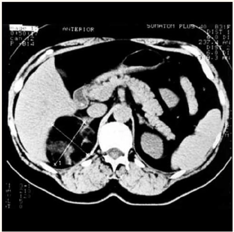 CT obraz ložiskového procesu v oblasti pravej nadobličky s denzitou tukového tkaniva (histologicky myelolipóm). Vľavo normálny obraz nadobličky.