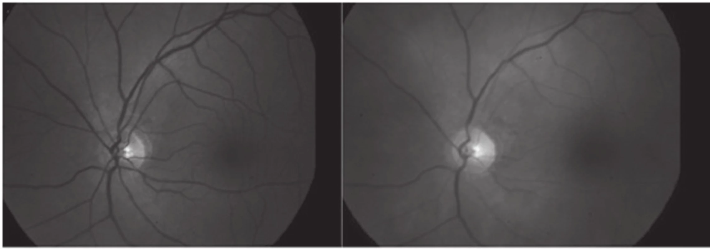 Porovnání obrázku fundu jednoho oka u totožného pacienta: vpravo obraz o vlnové délce 600 nm (arterie jsou výrazně tmavší než vény) a vlevo o vlnové délce 570 nm (arterie i vény mají téměř totožný vzhled)