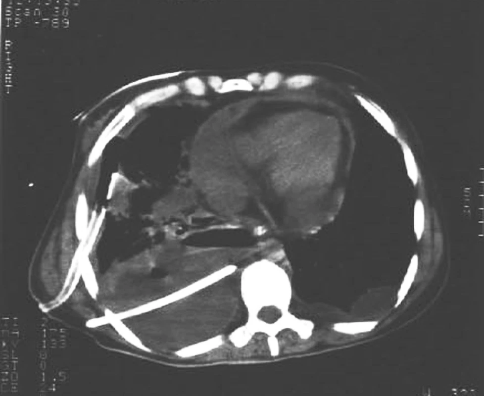 CT snímek hrudníku s drénovaným výpotkem
Fig. 1. A CT scan of a thorax with drained exudate