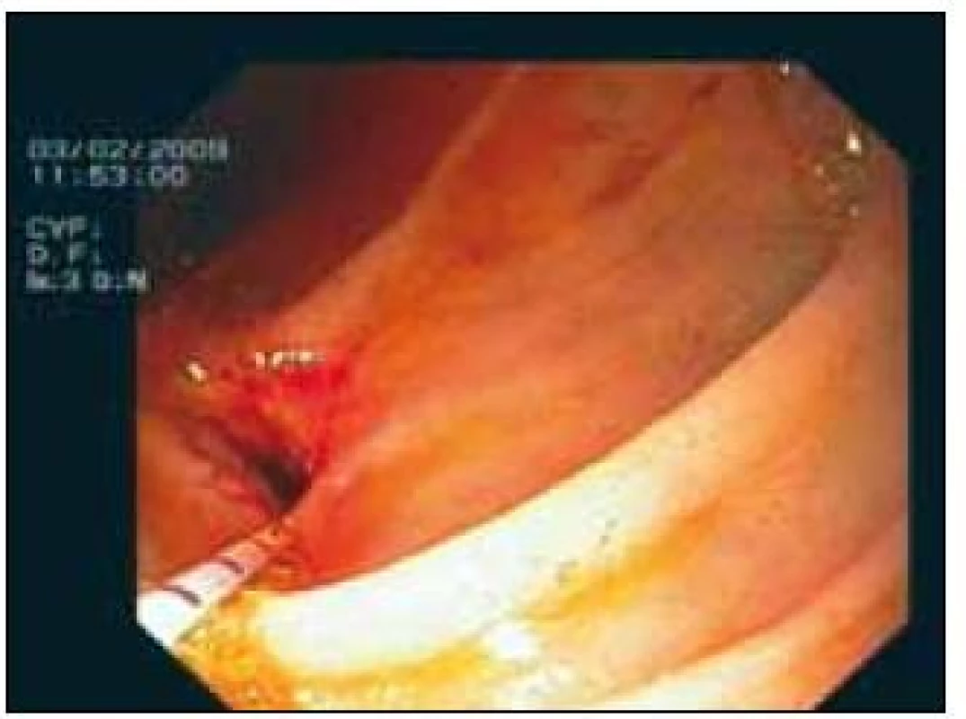 Endoskopický obraz – velice uspokojivý výsledný efekt endoskopické léčby stenotické HJA (se zavedeným vodičem).