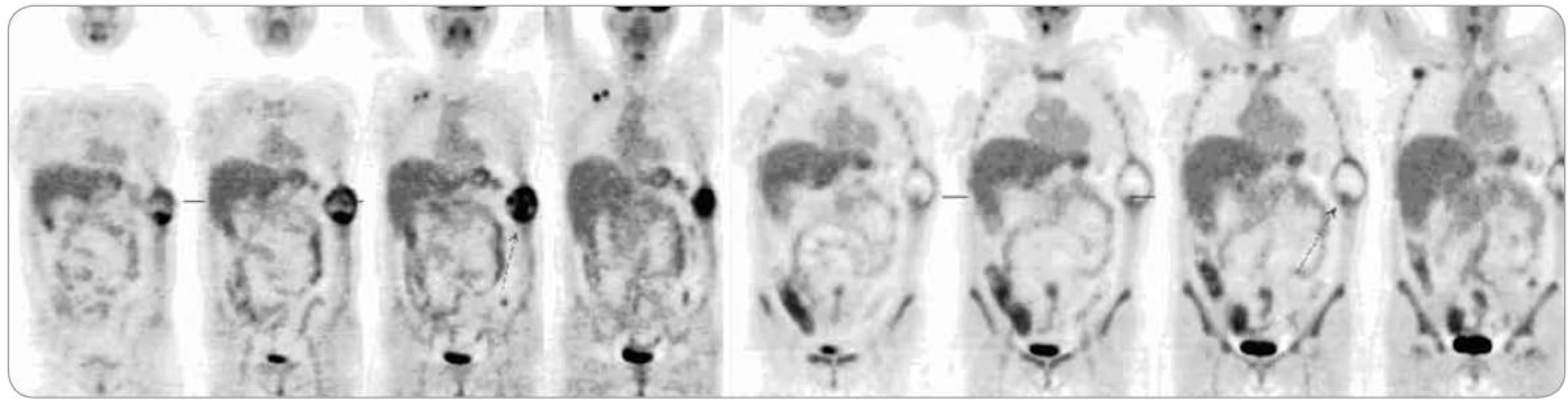 Srovnání PET vyšetření z ledna 2012 před zahájením léčby (vlevo) s vyšetřením z dubna 2012 po třech cyklech neoadjuvantní chemoterapie (vpravo). Je znatelný pokles aktivity tumoru hrudní stěny i pravostranné axilární lymfadenopatie.