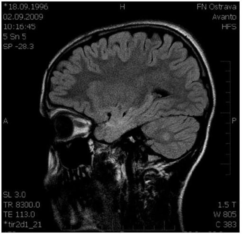Sagitální řez CNS: MR FLAIR, ložisko zvýšené intenzity signálu pravé mozečkové hemisféry.
Fig. 3. Sagittal section of CNS: MR FLAIR, a focus of increased signal intensity of the right cellular hemisphere.