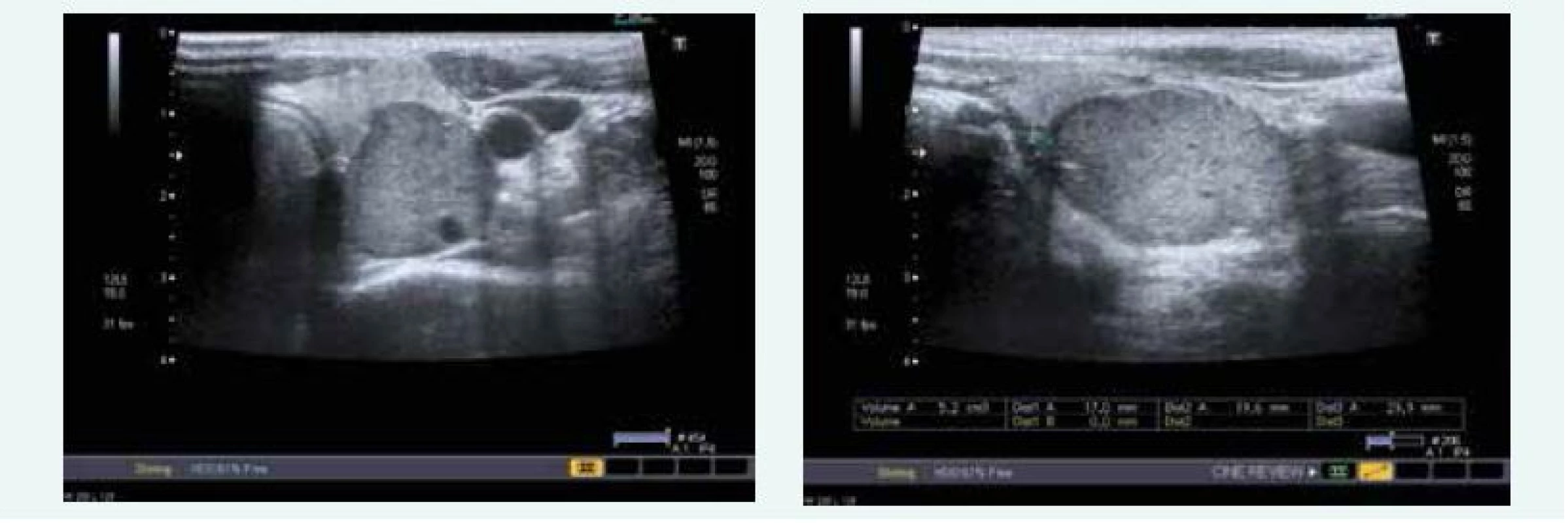 Kazuistika 4 – adenom levého dolního příštítného tělíska (USG) (snímky v plném rozlišení naleznete v on-line verzi článku)