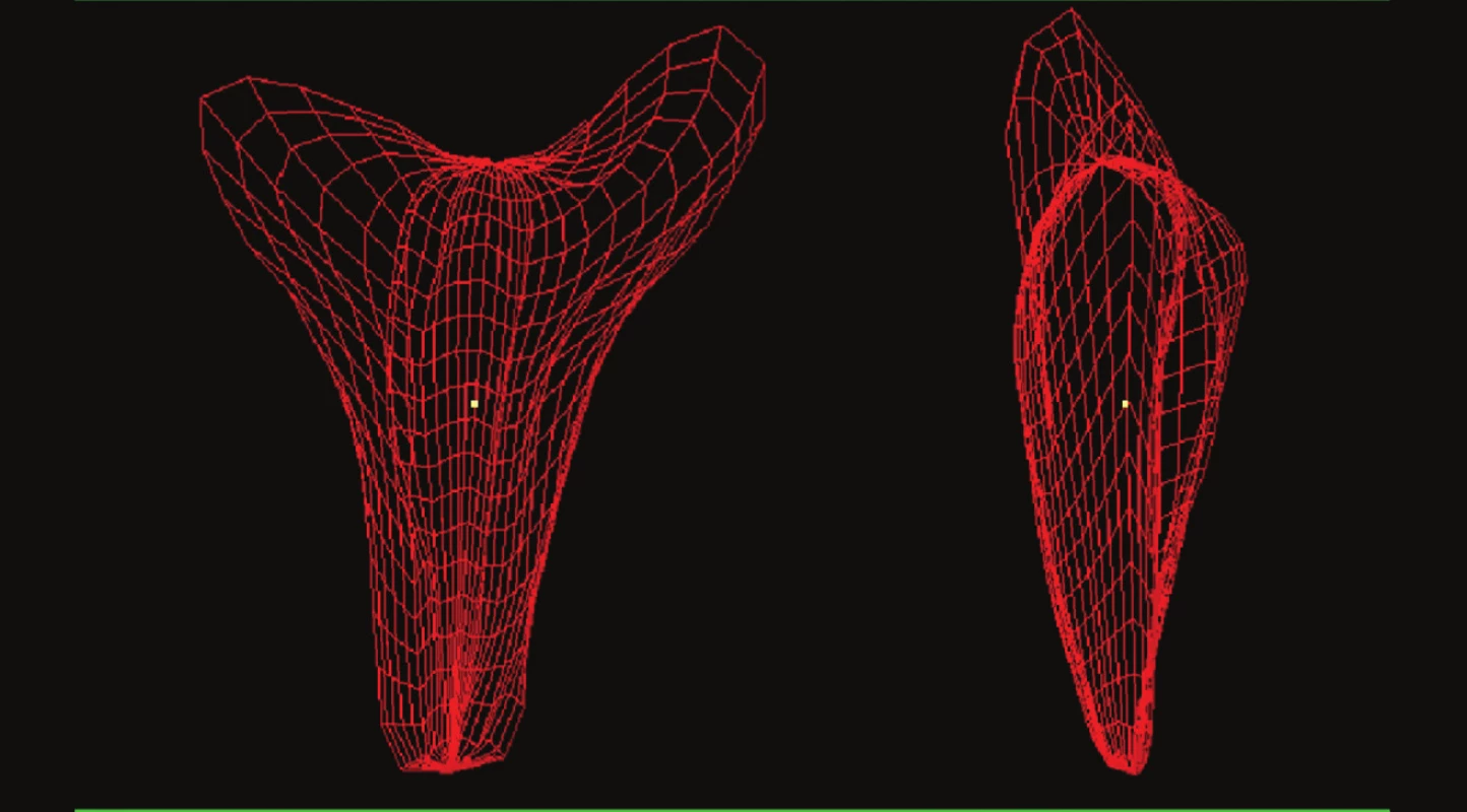 3D ultrasonografický ,,drátkový“ model endometria. Pokud je použito VOCAL programu ke kalkulaci objemu, 3D model endometria je tvořen při užití rotace a prohlížen v jeho přirozené orientační rovině. V tomto modelu pohled z koronální roviny, zřetelně patrný nalevo, demonstruje fundální defekt arcuátní dělohy, zatímco skutečná anteflexe dělohy může být lépe zhodnocena z bočního pohledu vpravo.