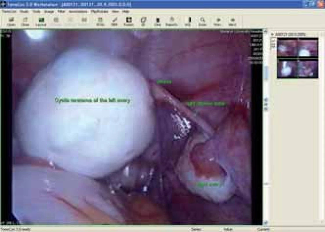 Snímek z laparoskopie - dermoidální cysta levého ovaria.