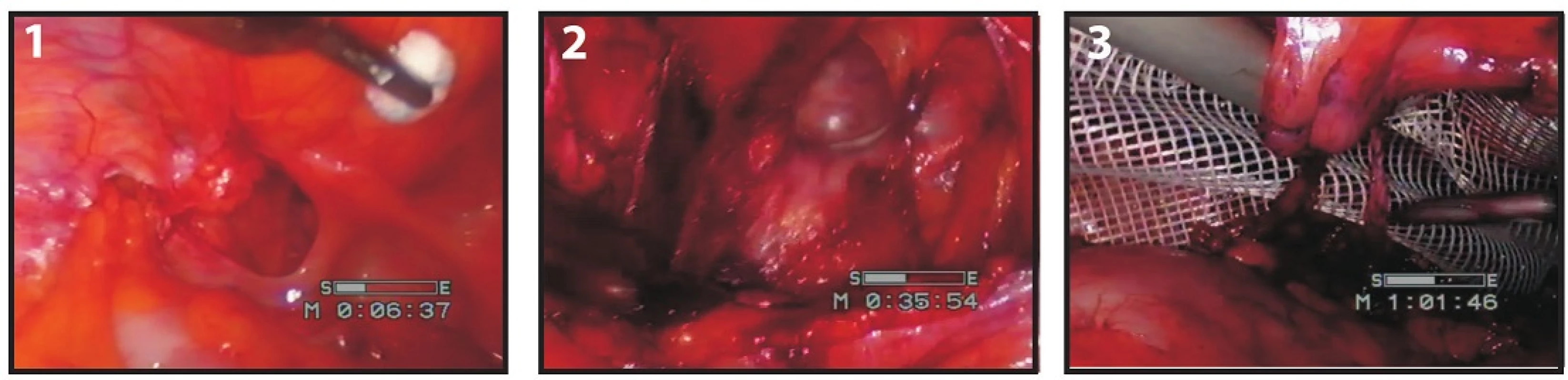 Operace supravezikální kýly – pacient 2
Fig. 2: Hernia supravesicalis surgery – patient 2