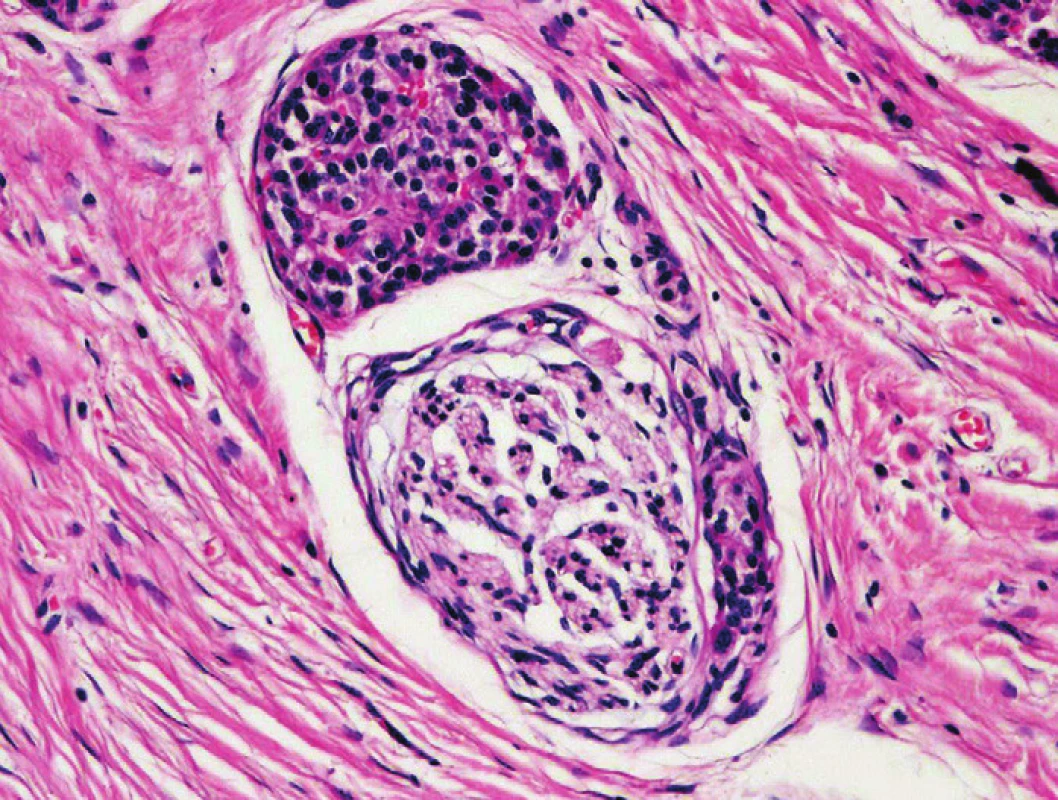 Struktura ostrůvku endokrinního pankreatu adherující k perifernímu nervu v terénu CP. Barveno hematoxylinem eozinem (zvětšení 200x).
