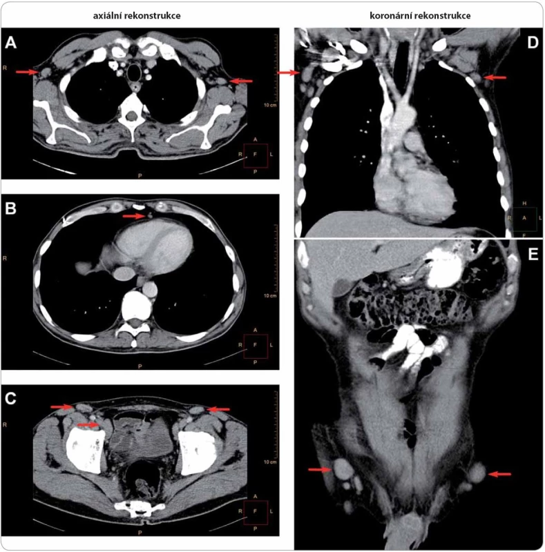 Generalizovaná lymfadenopatie u případu 4 na CT hrudníku, břicha a pánve.