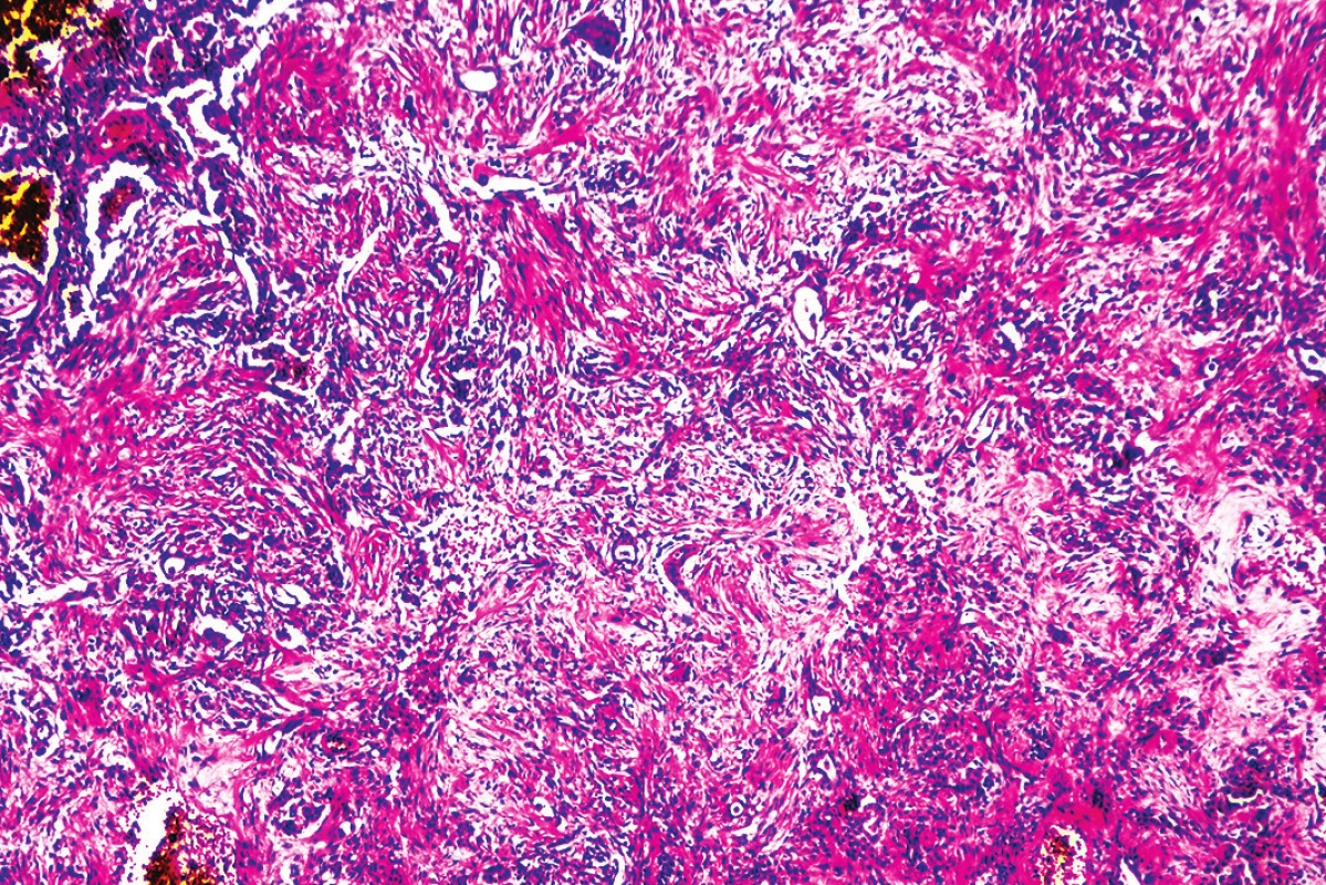 Rozsiahle areály pľúcnej fibrózy (hematoxylín-eozín, zväčšenie 40x).