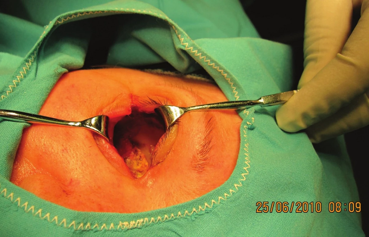 Klinický obraz po exenterácii, hojenie dutiny bez komplikácií