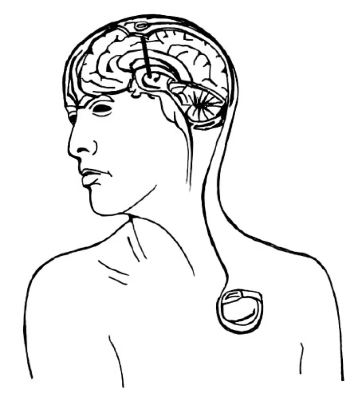 Schéma implantovaného stimulačního systému (elektroda, spojovací kablík, neurostimulátor)