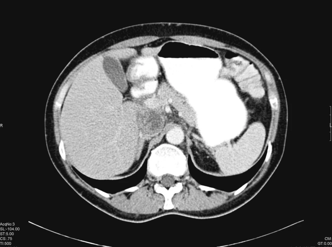 Masa tumoru v průsvitu v. cava v CT obraze
Pic. 1. Mass of tumor invading into v. cava inf. in CT picture