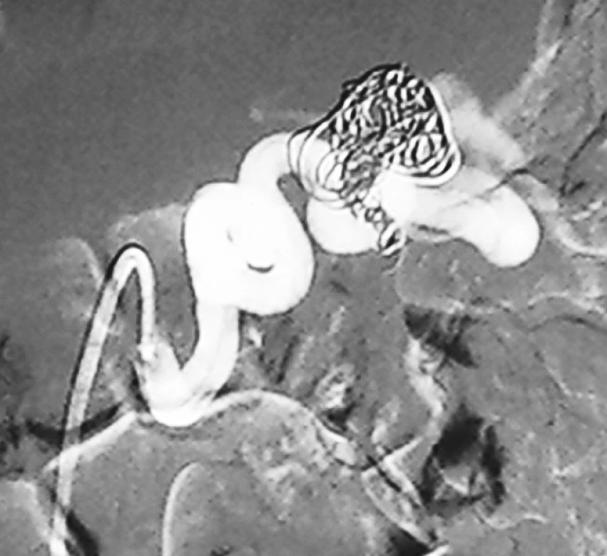 Coil embolizace aneuryzmatu lienální tepny (DSA)
Fig. 4. Coil embolization of the lienal artery aneurysm (DSA)