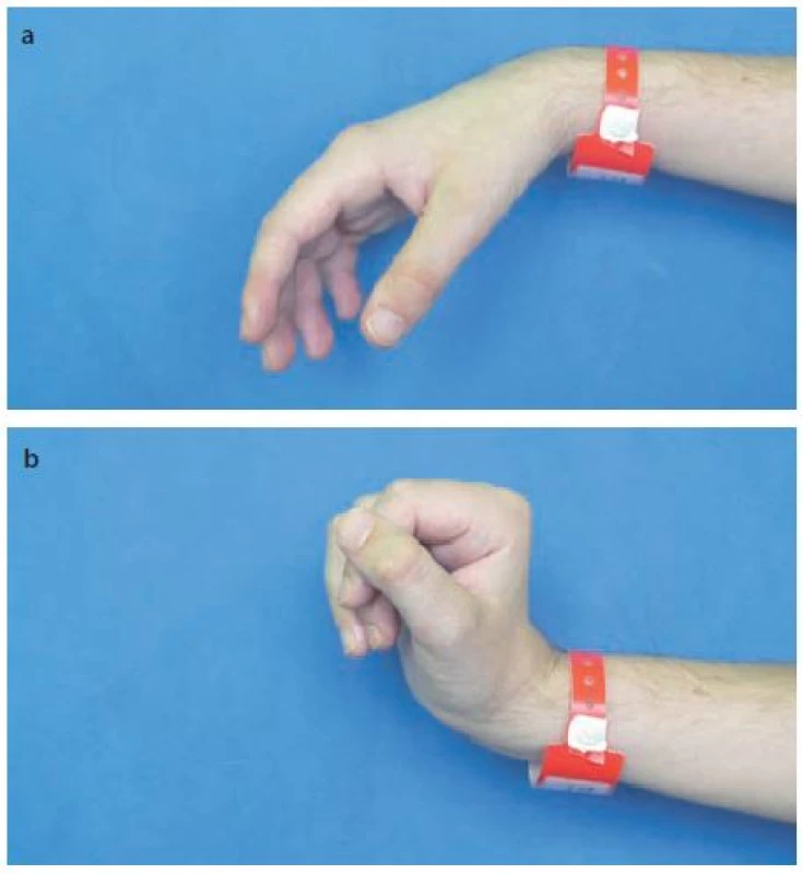 Náhradní funkční úchop tetraplegika s míšní lézí C6.
Obr. 4a) Pasivní nastavení akra před úchopem, plegické prsty jsou ve volné semiflexi.
Obr. 4b) S aktivní dorzální flexí zápěstí se při tenodéze hlubokých flexorů prstů přimknou prsty pasivně do dlaně.
Fig. 4. Tenodesis grip of a tetraplegic patient with the C6 spinal lesion.
Fig. 4a) Passive acrum setting prior to the grip, plegic fingers are in a loose semiflexion.
Fig. 4b) Active dorsal flexion of the wrist with deep finger flexor tenodesis press the fingers passively into the palm.