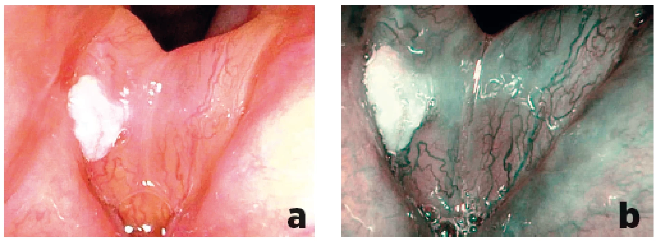 Porovnání zobrazení leukoplakie pravé hlasivky při flexibilní endoskopii bílým světlem (a) a při NBI endoskopii (b) – v NBI endoskopii benigní vaskularizace, Typ III, histologicky prokázána lehká dysplazie.