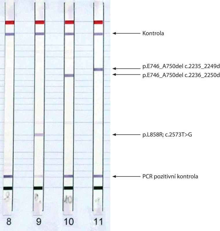 Výsledky analýzy mutací genu EGFR získané metodou real-time PCR (E746_A750del ve vzorcích A a C) (A) a metodou reverzní hybridizace s vyznačenými detekovanými mutacemi (B).
