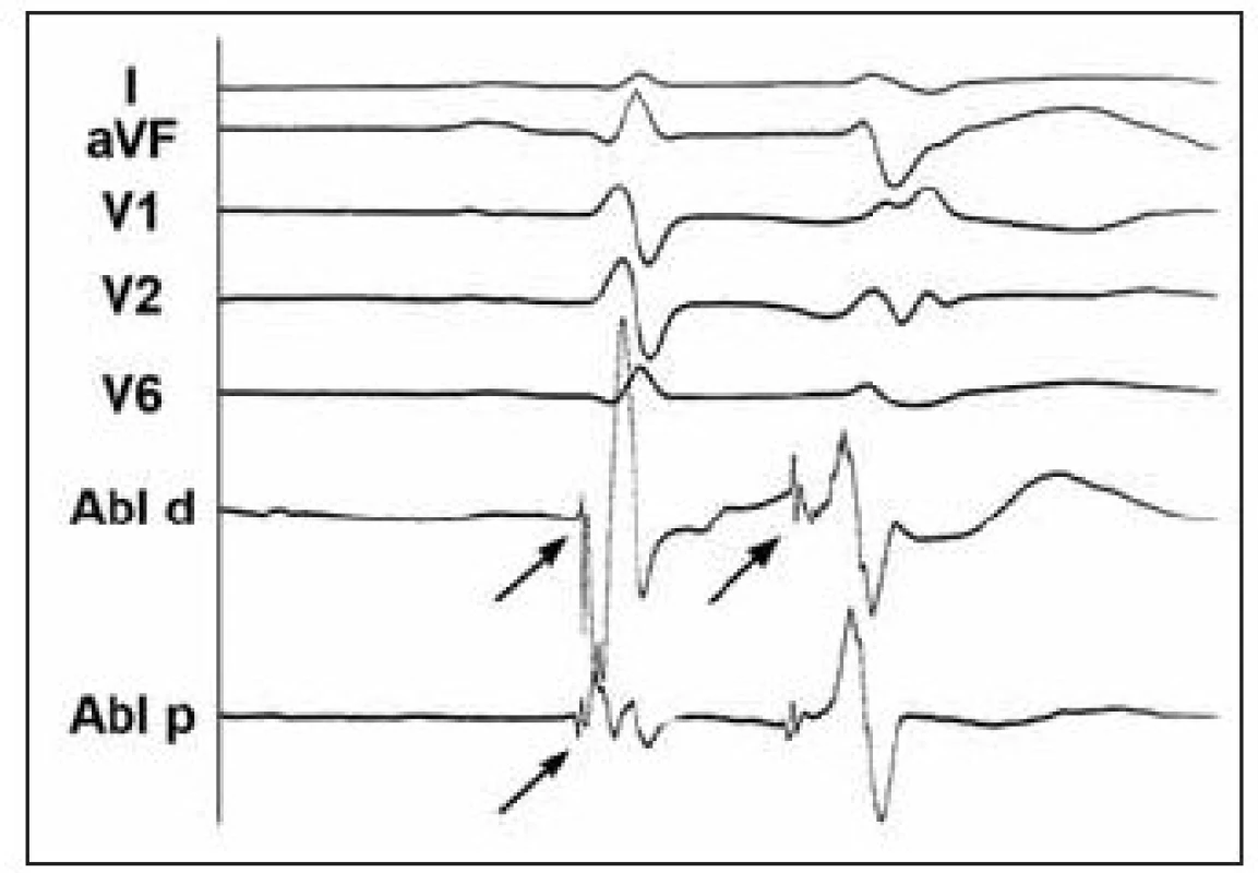Povrchové EKG a intrakardiální elektrogram z oblasti komorové ektopie iniciující maligní arytmie u nemocného s idiopatickou formou FK.
Intrakardiální elektrogram z oblasti zadního fasciklu levého raménka Tawarova během sinusového rytmu a při komorové extrasystolii dokumentuje přítomnost vysokofrekvenčního potenciálu s nízkou amplitudou (šipky). Tento potenciál předcházel komorovou aktivaci při extrasystole 60–80 ms, zatímco při sinusovém rytmu o pouhých 10–15 ms. Větší předčasnost při ektopii svědčí pro vznik v tkáni převodního systému.