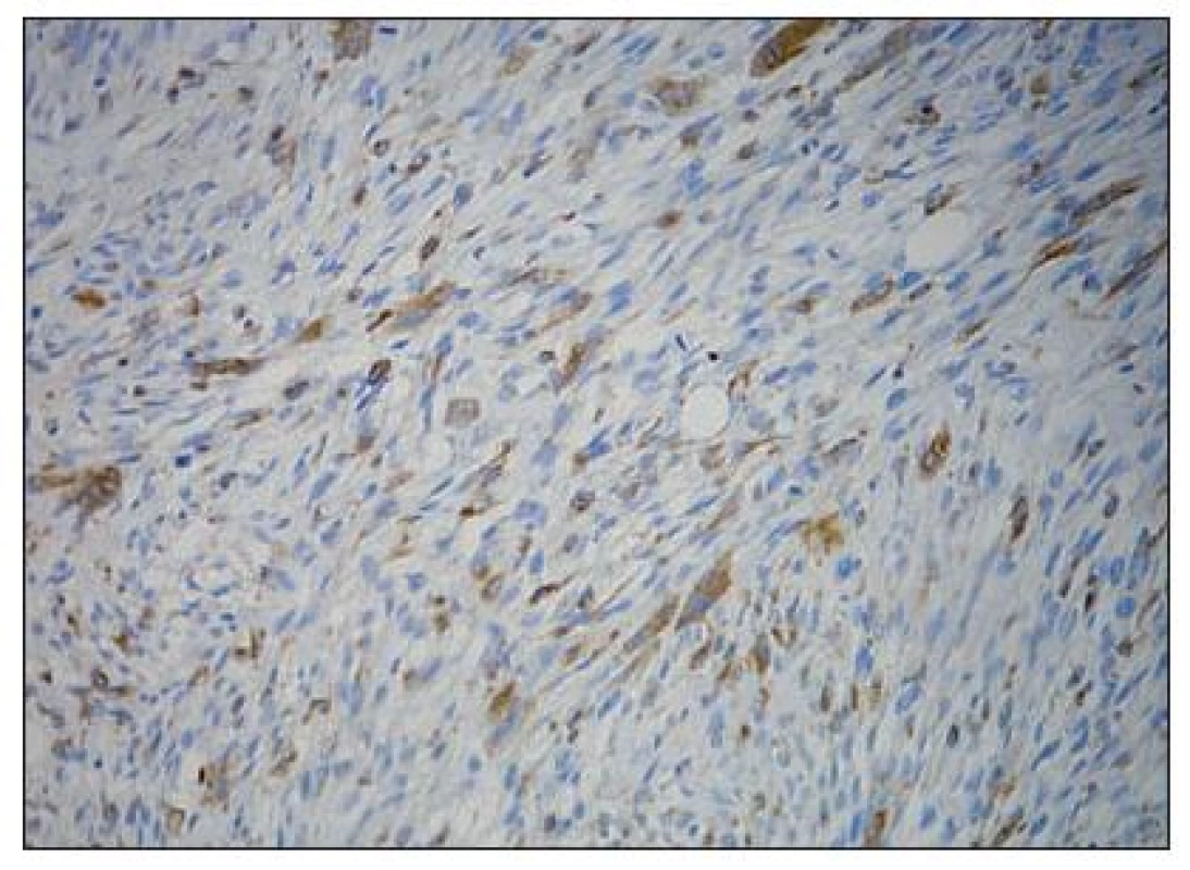 Imunohistochemický průkaz pozitivity histiocytárního markeru CD 68 v některých histiocytoidních a vícejaderných nádorových buňkách (originální zvětšení 200×)