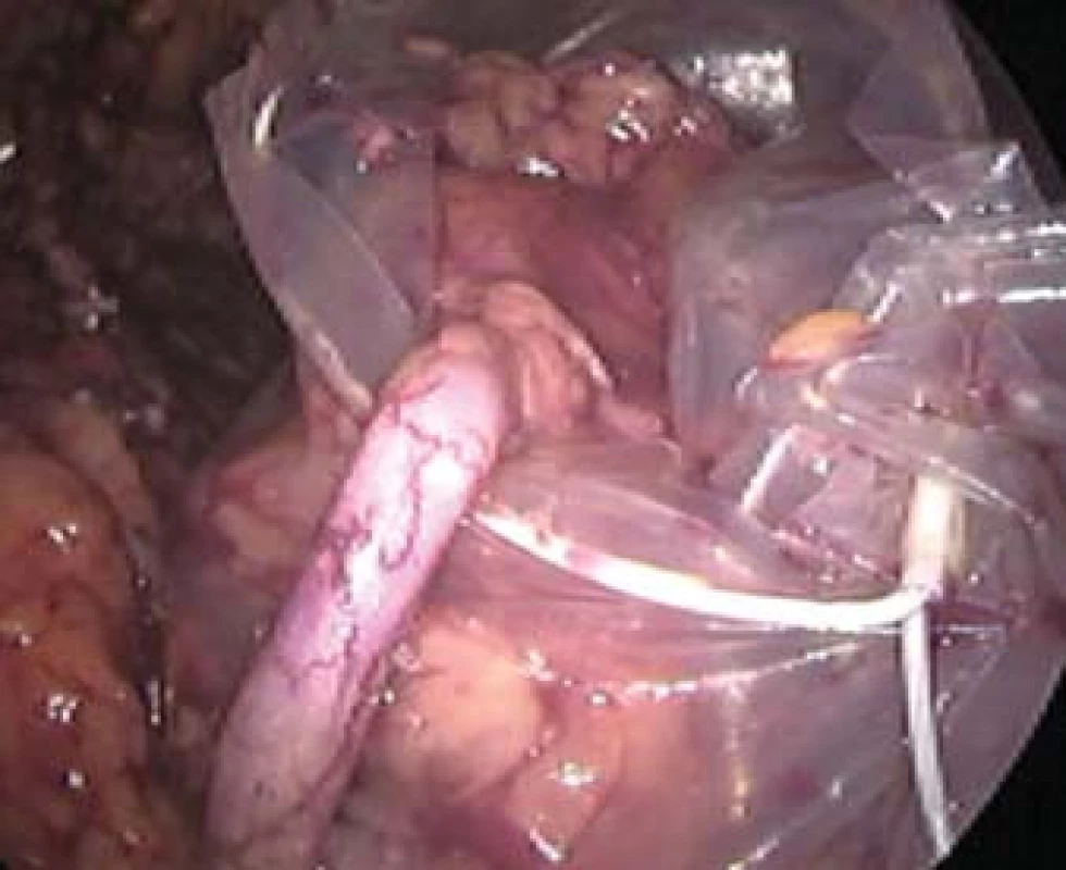Snímek pořízený z videozáznamu z laparoskopie. Preparát nefrektomovavé ledviny je uložen do extrakčního sáčku, z něhož vychází nepřerušený ureter.
