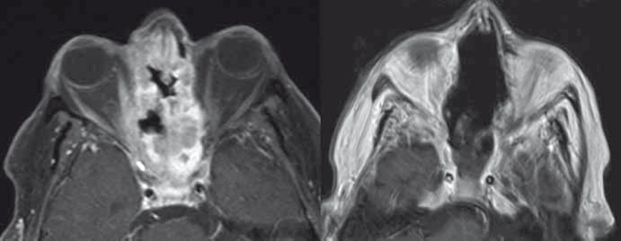 Adenokarcinom etmoidů a dutiny nosní s invazí do mediálních stěn očnic a baze přední jámy lební před (vlevo, T1 vážená sekvence MR s potlačením tuku a podáním kontrastní látky) a po radikální resekci (vpravo, T1 vážená MR sekvence s podáním kontrastní látky).