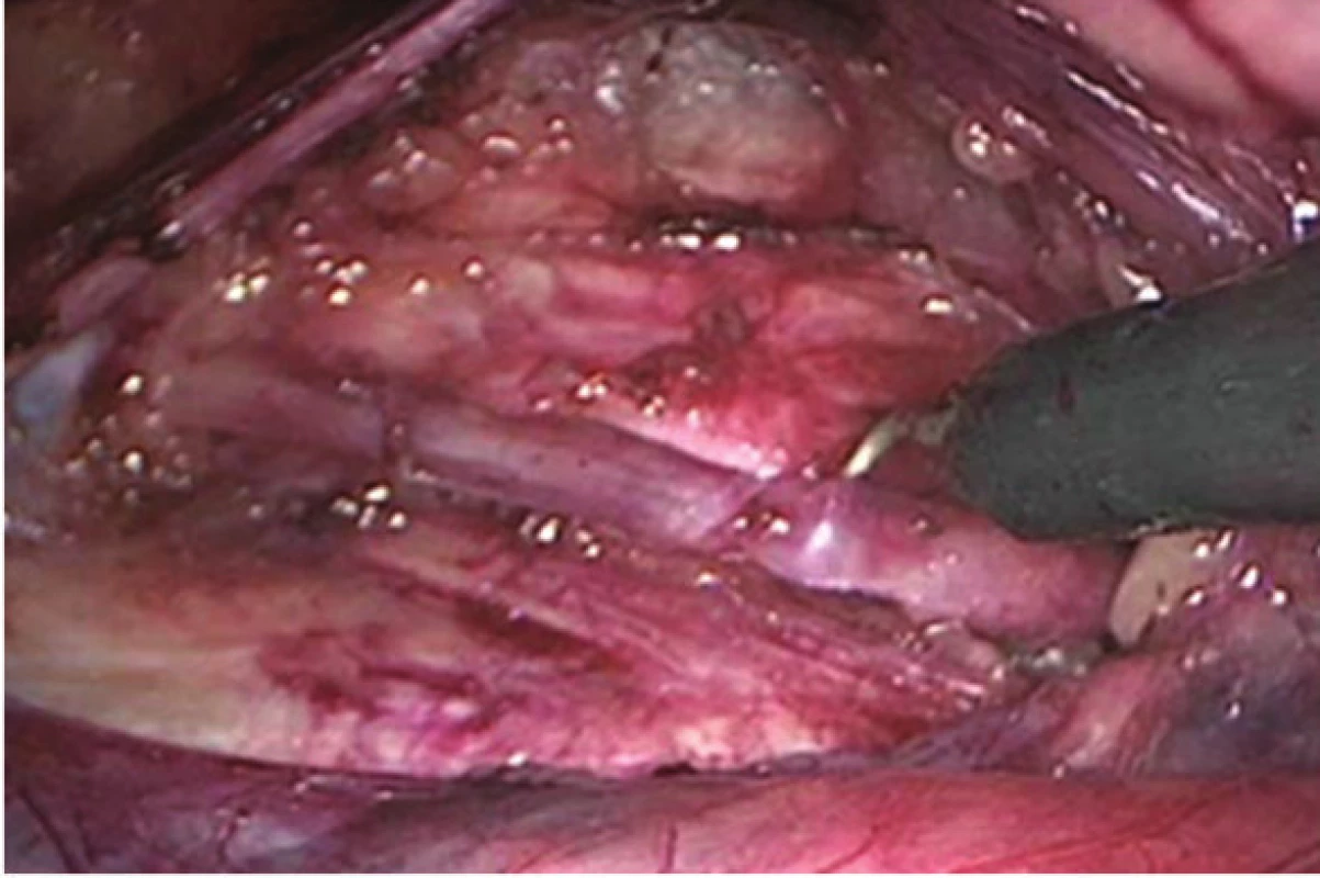 Pravostranný sympatikový kmeň, záber z laparoskopickej optiky
Fig. 2. Right sympathetic trunk – laparoscopic view