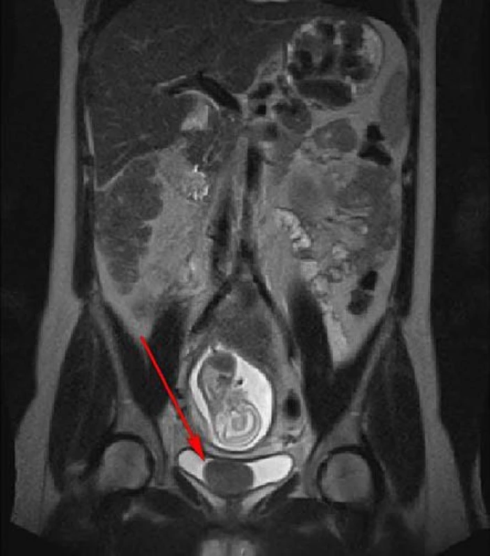 MR, koronární řez, T2 vážený obraz: homogenní, ohraničený, hladký, kulovitý útvar
v močovém měchýři
Fig. 1. MR scan, coronal section, T2 weighted image: homogenous, smoothly marginated mass in the urinary bladder