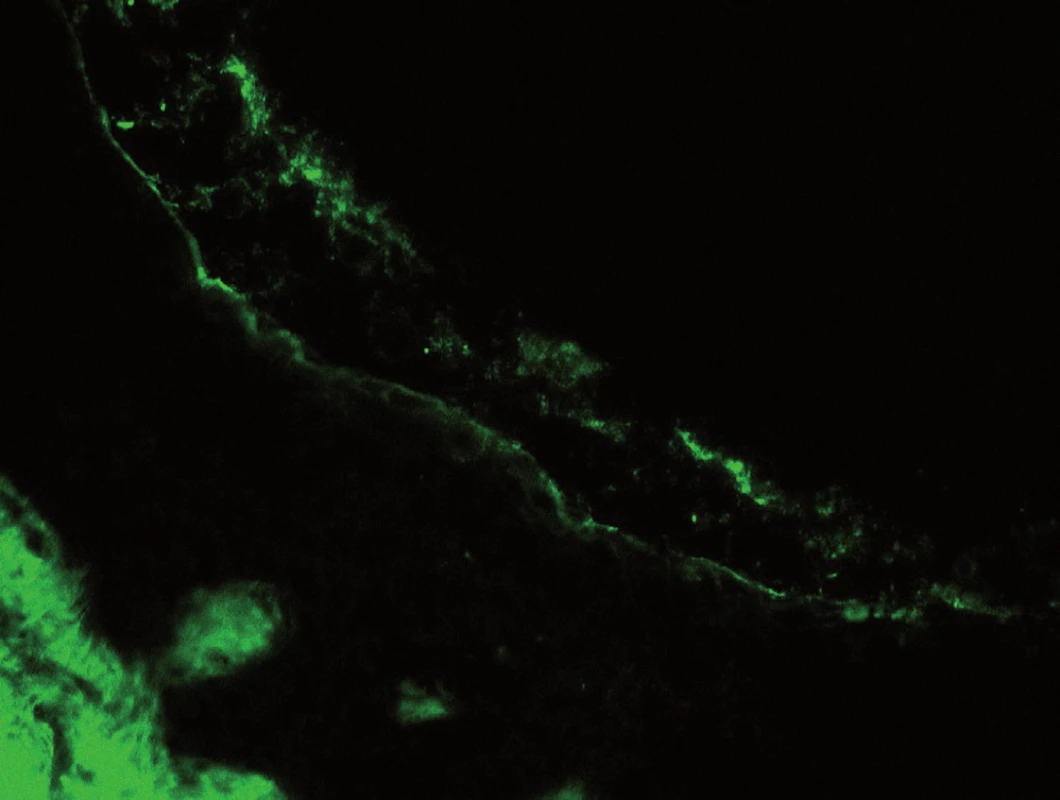 Pozitivní fluorescence ve spodině vezikuly, prokazující přítomnost imunoglobulinu typu IgA.