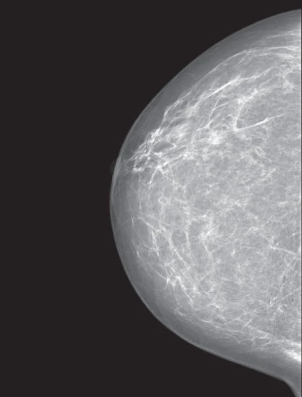 Mamogram – nízce denzní žláza Tabár II