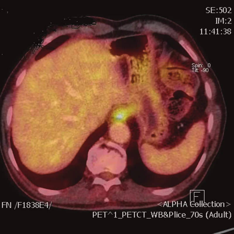 Obraz tumoru kardie na PET/CT
Fig. 1: PET/CT scan of tumor of the gastroesophageal junction