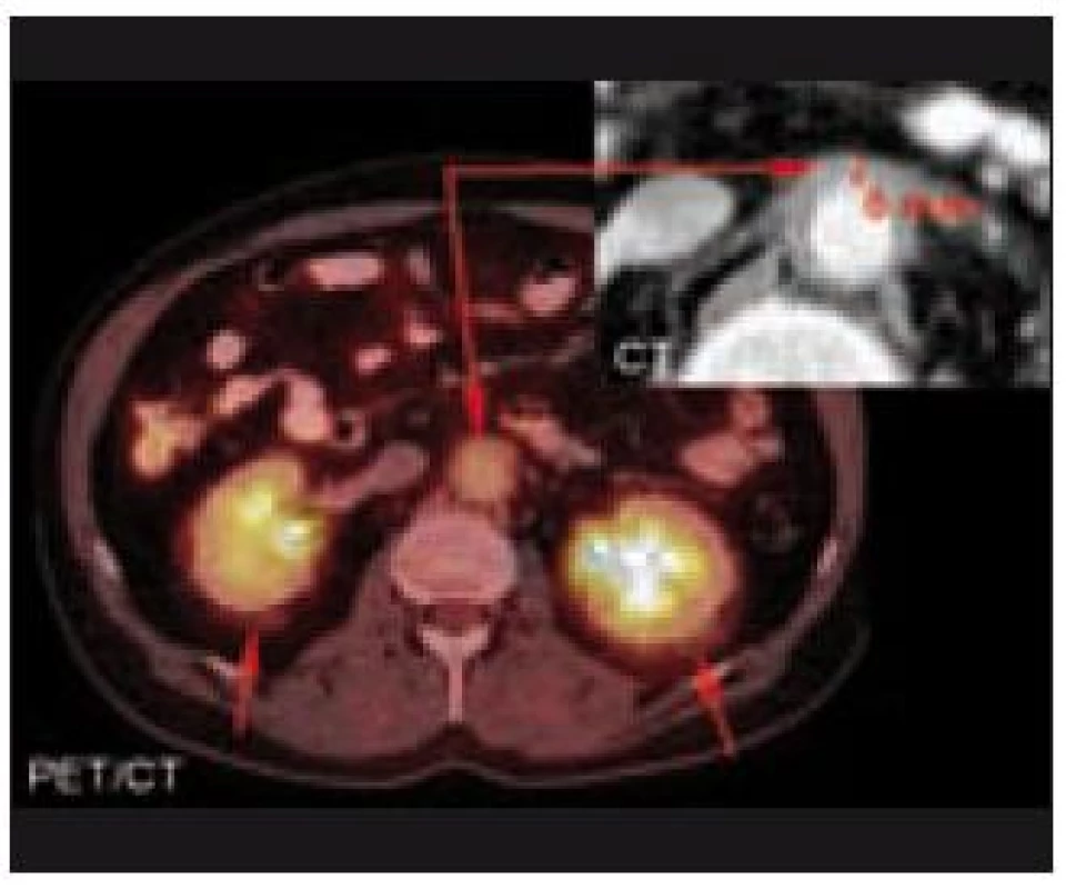 CT a PET/CT břicha. Zvýšení denzity perirenálního tuku, zneostření kontur obou ledvin, více vlevo. Naznačeno cirkulární zesílení stěny břišní aorty místy až na 6 mm v průměru (méně výrazný je nález též na hrudní aortě a na společných ilických tepnách těsně pod bifurkací aorty, více vpravo). PET komponenta zachycuje difuzně zvýšenou aktivitu FDG v místech perirenálních a periaortálních změn.