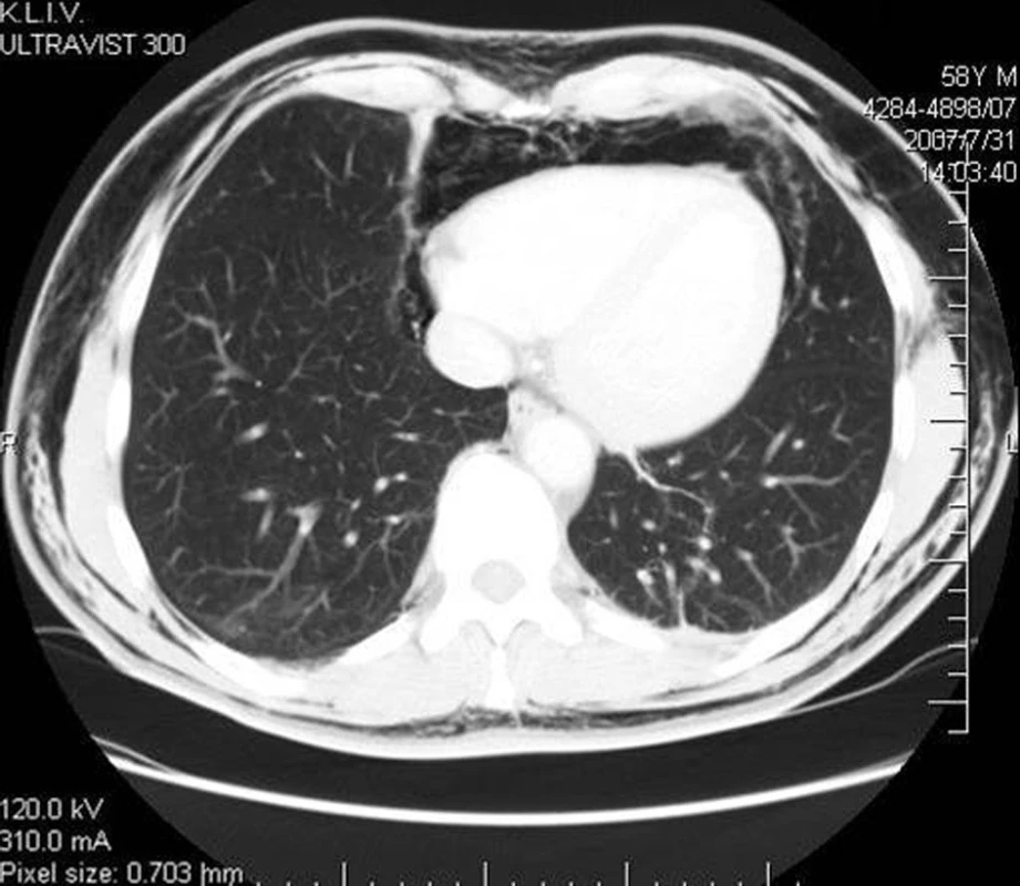 CT plic s pneumomediastinem
Fig. 7. Thorax CT with pneumomediastinum