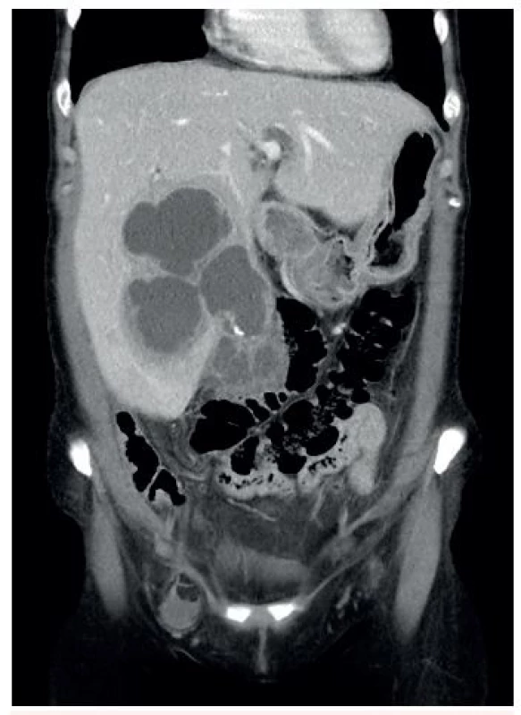 CT břicha s kontrastní látkou v portální fázi, koronární rovina, rozsáhlý multilokulární absces v pravém laloku jater
