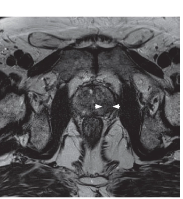 3T MRI prostaty T2 vážený obraz – nález tumoru v levé periferní zóně (hypointenzní oblast) 
Fig. 1. T2 weighted 3T MRI – tumor focus in the left peripheral zone (hypo-intense region)