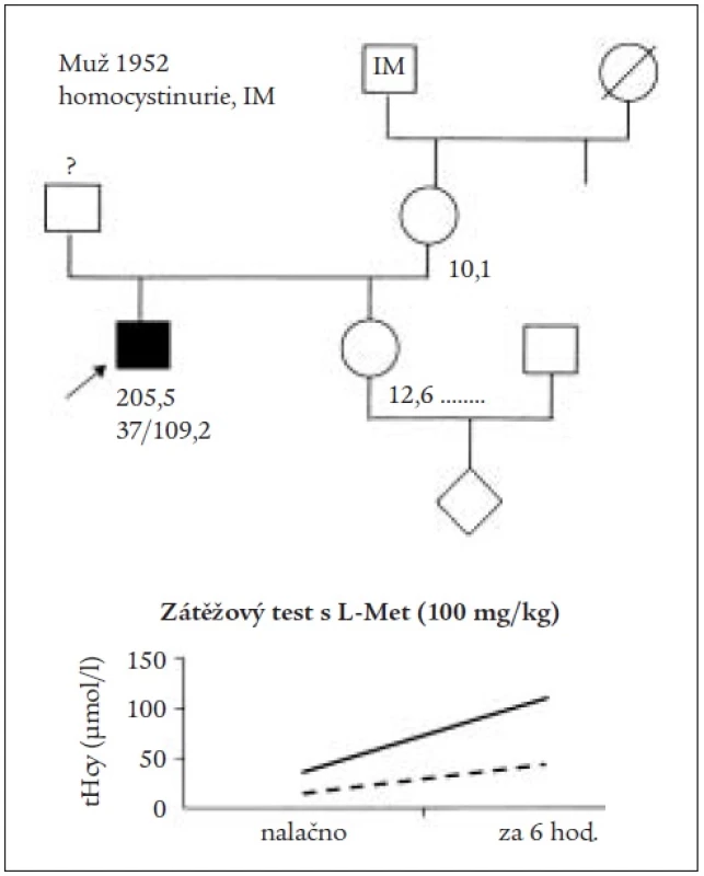 Rodokmen pacienta s klasickou homocystinurií a infarktem myokardu doplněný o výrazně pozitivní výsledek zátěžového testu s L-methioninem.