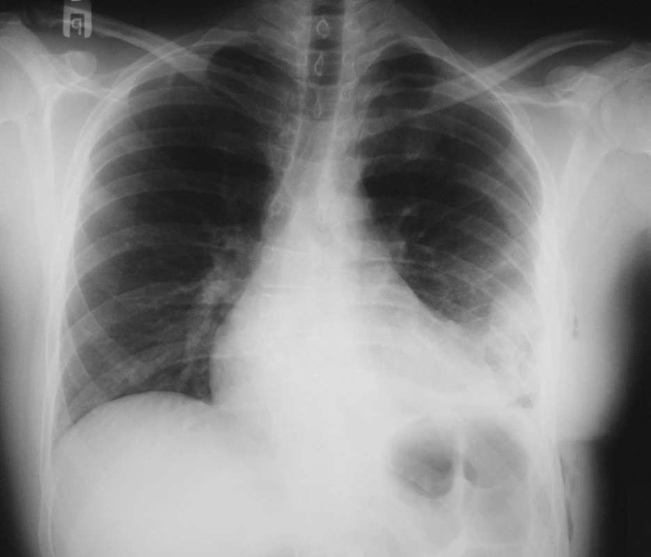 RTG hrudníku po chirurgické léčbě
Fig. 2. X-ray of chest after surgical treatment