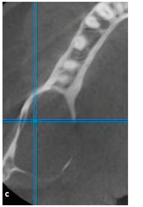 Ortopantomogram s nálezem rozsáhlé folikulární cysty v místě zubu 48 (a). Jednalo se o náhodný nález při preventivní prohlídce u praktického zubního lékaře. CBCT bylo provedeno na klinickém pracovišti (b, c).