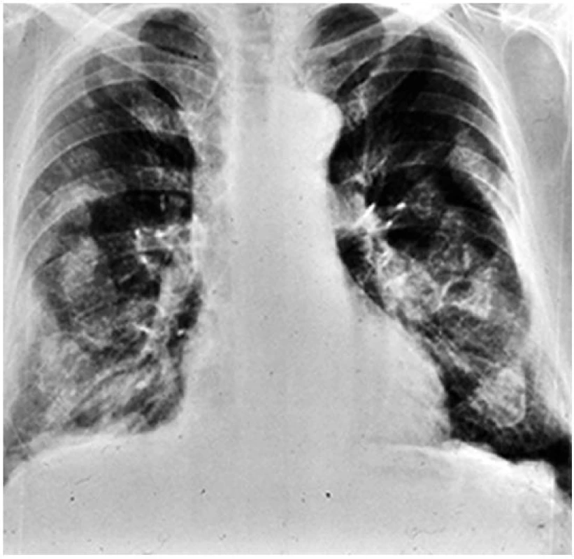 Předozadní snímek hrudníku u pacienta s azbestózou
Při detailním zhodnocení snímku lze nalézt charakteristické postižení pleury – tzv. pleurální plaky seskupené přibližně podél žeberních oblouků.