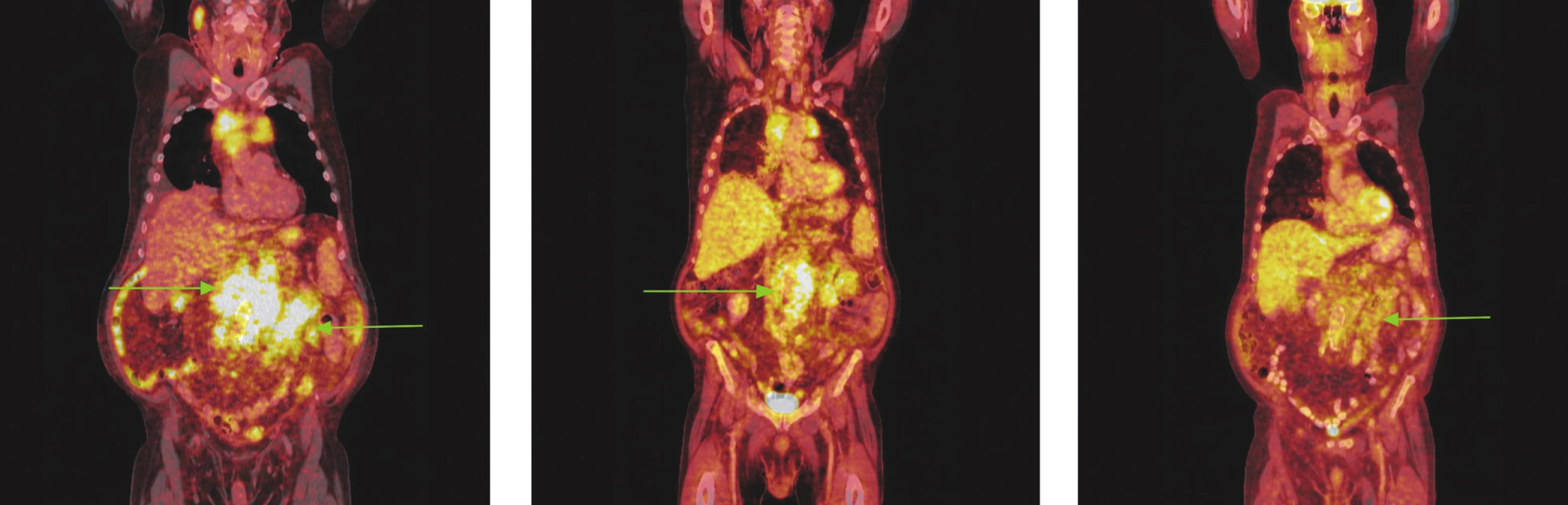 Série PET/CT snímků u nemocného s folikulárním lymfomem před léčbou, po 2 cyklech léčby a po záchranné chemoterapii. Na prvním snímku nalezen hypermetabolismus glukózy ve zvětšených lymfatických uzlinách a jejich paketech na krku, ve všech oddílech mediastina, před pravým jaterním lalokem a v břišní dutině. Pakety v mediastinu komprimují horní dutou žílu a levou brachiocefalickou žílu, do obrovského paketu lymfatických uzlin v dutině břišní jsou zavzaty pankreas a levá nadledvina. Oboustranný fluidothorax. Na snímku po 2 cyklech imunochemoterapie došlo jen k částečné regresi patologického nálezu, lymfatické uzliny i jejich pakety se zmenšily, přetrvává v nich však stále hypermetabolismus glukózy. Pacient pro tento nález a kumulaci dalších rizikových faktorů indikován k záchranné imunochemoterapii R-EDHAP. Po 2 cyklech této léčby sice přetrvávají měkkotkáňové masy v mediastinu, retroperitoneu a mezenteriu, nevykazují však hypermetabolismus glukózy.