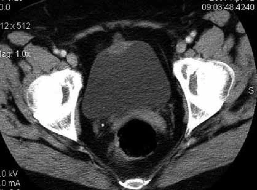 Karcinom urachu – CT scan
Fig. 1. Urachal carcinoma – CT scan