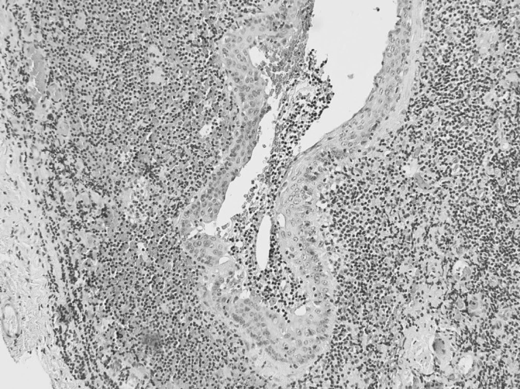 Výstelka benigní lymfoepiteliální cysty tvořená nedysplastickým dlaždicovým epitelem. Ve stěně cysty lymfatická tkáň s formacemi sekundárních lymfatických foliklů (hematoxylin-eosin, originální zvětšení 100x).
Pic. 1. A benign lymphoepithelial cyst lining, consisting of adysplastic epithelium. Lymphatic tissue with secondary lymphatic folicles formations within the cyst wall (HE staining, original enlargement 100x)