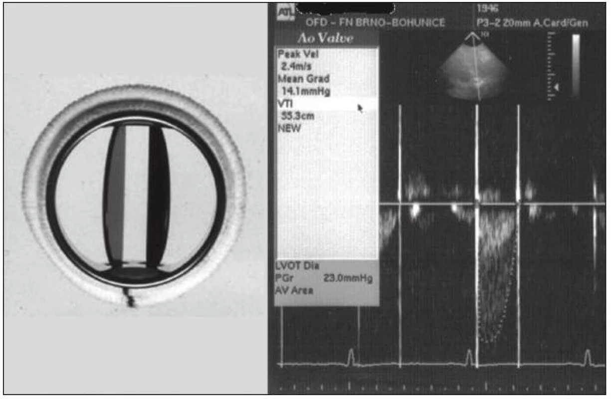Reziduální tlakový gradient na mechanické chlopenní protéze typu SJM (Saint Jude Medical): vrcholový 23, střední 14 mm Hg.