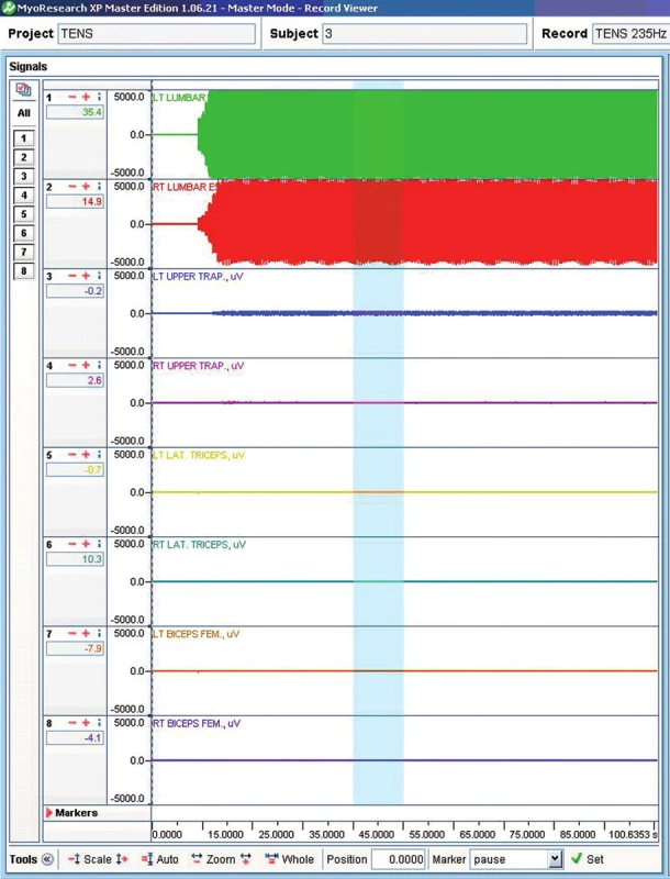 Ukázka grafického záznamu EMG aktivity.