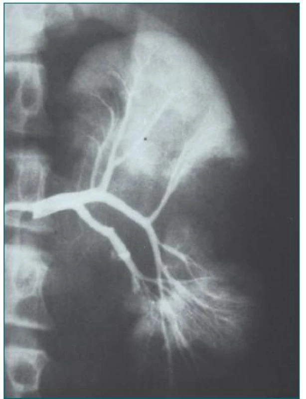 Trauma ledviny – kopnutí koněm do přední strany břicha, řešeno konzervativně.