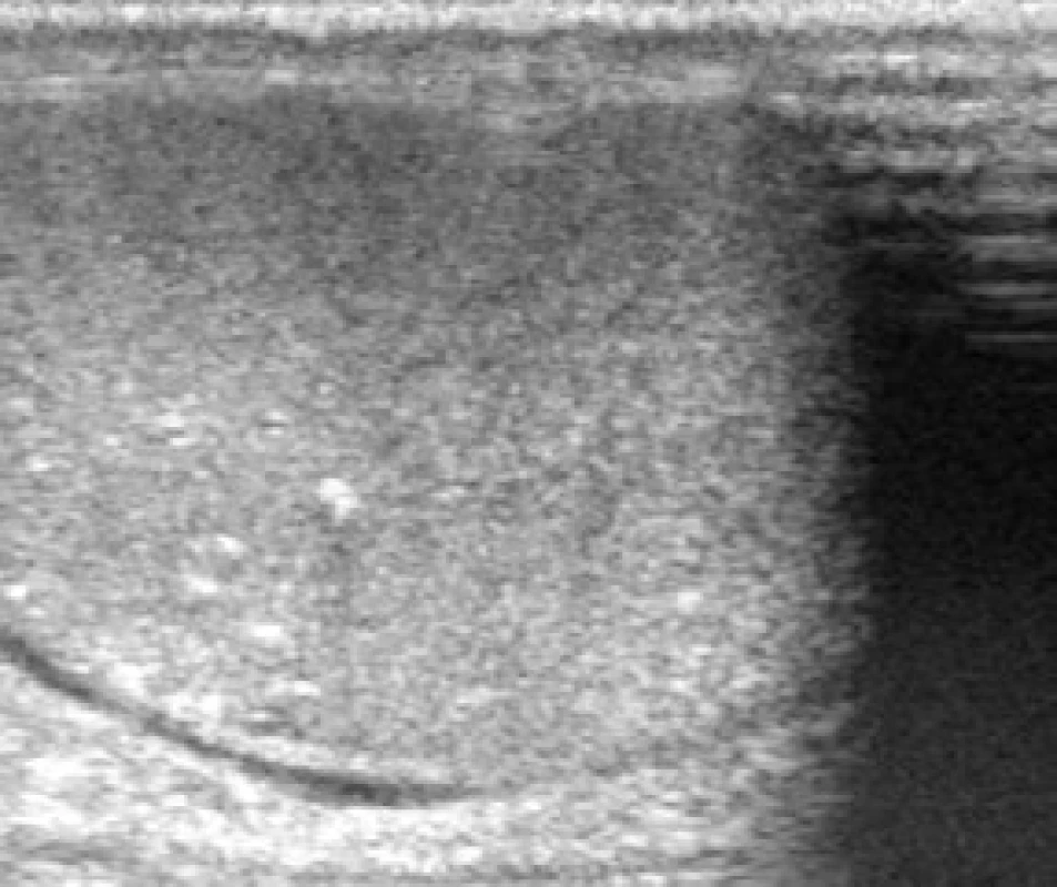 Ultrazvukový nález mikrolitiázy horního pólu pravého varlete 
Fig. 1. Testicular microlithiasis of right testis