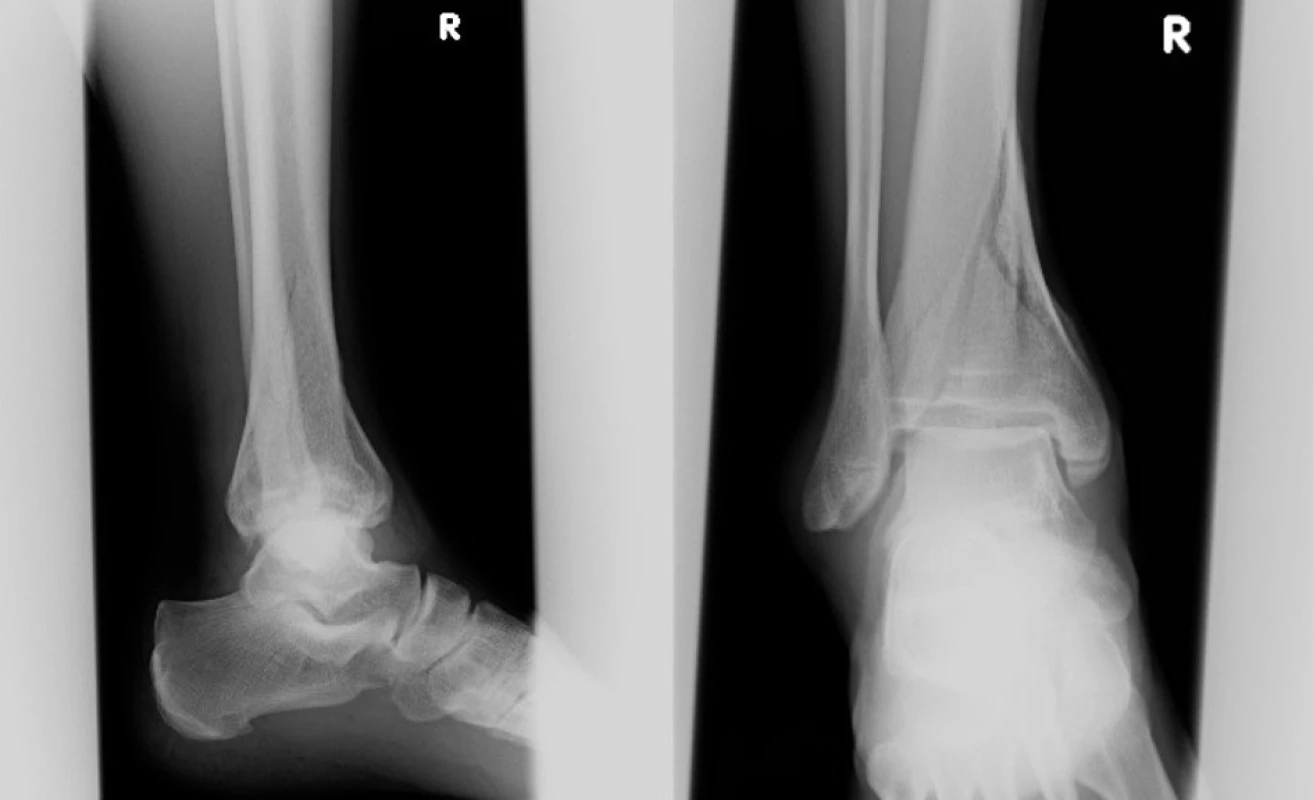 Vstupní rtg recentně po úrazu
Fig. 2: Initial X-ray shortly after injury